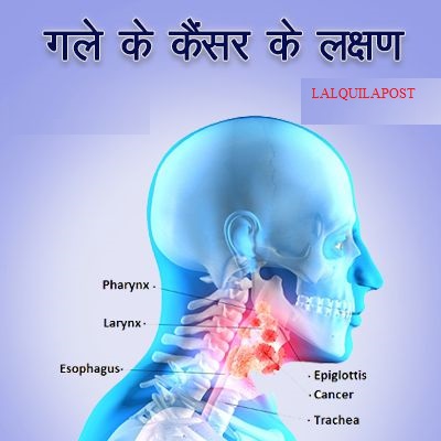 LALQUILAPOST-Gale-Ke-Cancer-Ke-