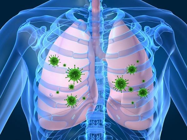 lalquilapost-lungs infection